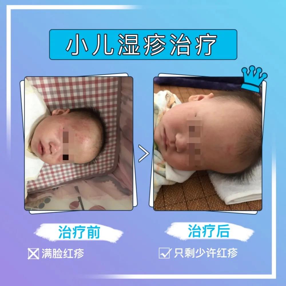汉古中医：小儿推拿治疗新生婴儿湿疹