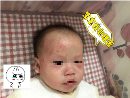 汉古中医：小儿推拿治疗新生婴儿湿疹