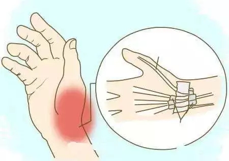 上海琉璃光中医：鼠标手、手指关节疼痛的治疗与保养