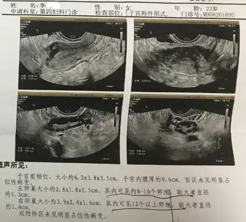 上海民顺中医：多囊卵巢综合征治愈两则