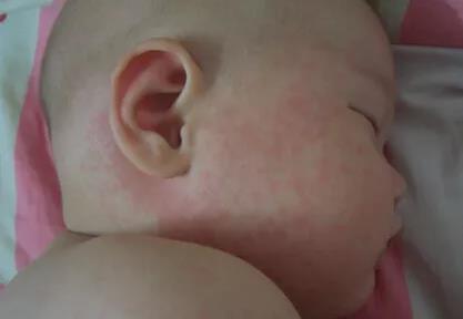 苏州康泰堂：预防儿童高发的8种皮疹