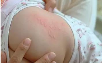 苏州康泰堂：预防儿童高发的8种皮疹