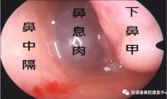 扬州炏焱中医：了解了鼻息肉，才知道鼻炎不可小觑！