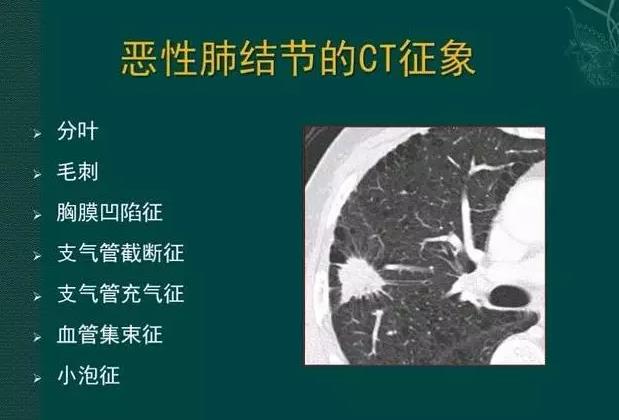 杭州保誉堂：中医讲解恶性肺结节特征