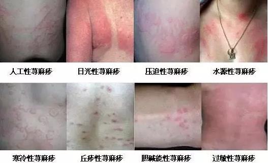台州龙华中医：让人心塞的皮肤瘙痒