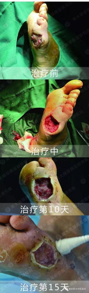 南京太乙堂:骨髓炎，真的那么可怕吗？