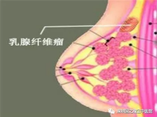 深圳国之瑰宝中医馆：（医案）中医药治疗乳腺纤维瘤