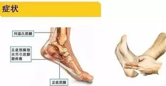 深圳国之瑰宝中医馆：（医案）中医药治疗足跟痛