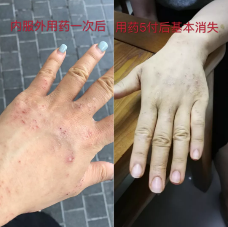 深圳任医生中医馆：（医案）冯步珍教授治疗湿疹药到病除！