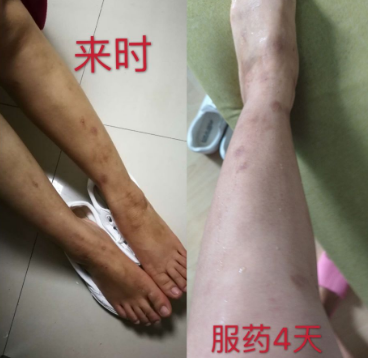 深圳任医生中医馆：（医案）冯步珍教授治疗湿疹药到病除！