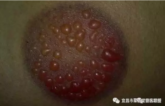 宜昌市聚杏堂：拔罐拔出水泡 是医生技术差还是湿气重。