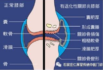 石家庄新华仁厚堂：膝关节炎怎么形成的