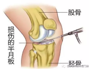 石家庄新华仁厚堂：膝关节炎怎么形成的