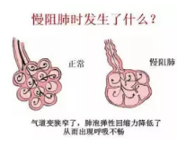 益阳津湘国医馆：带您认识慢性阻塞性肺病