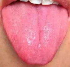 永州恒康中医院馨恒堂：舌头中间有裂纹，是『大病征兆』？