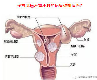 济南福济中医： 不得不防的子宫肌瘤