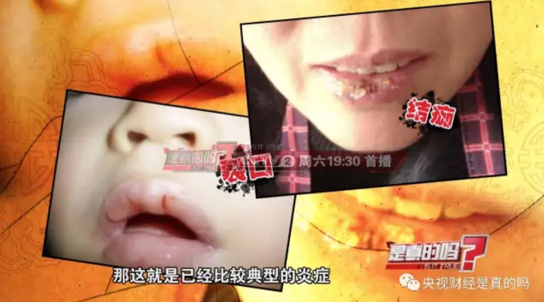 济南裴医堂：嘴唇总是起皮，那是内脏在求救！
