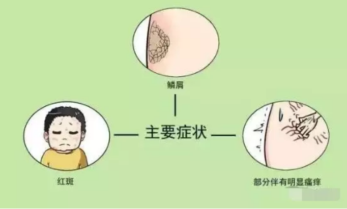 济南麒医堂：银屑病（牛皮癣）如何治疗？