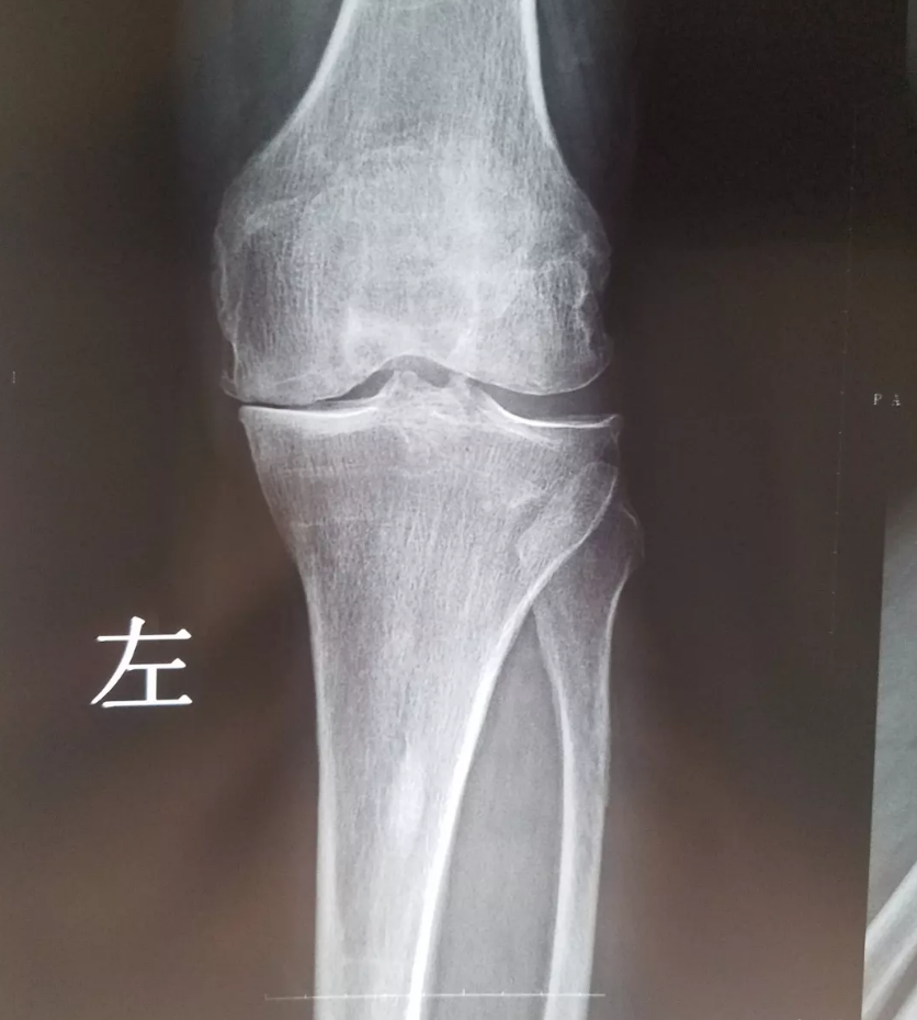 青岛天道中医：膝关节疼痛为何常年不愈 上下楼膝盖痛可以治疗吗