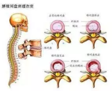 赤峰名医馆：如何自测腰椎间盘突出症
