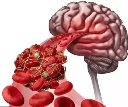 国宗中医医院：头部出现四个异常，说明脑血管堵塞严重！