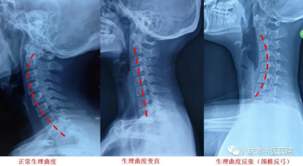 大庆市中医医院：牵引＋针灸＋推拿 综合疗法“整治”颈椎病