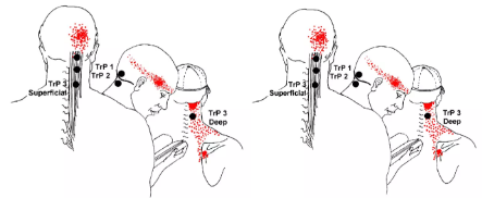 佳木斯市德济中医：为什么多数头痛都缘于颈椎？