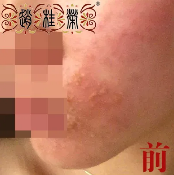 牡丹江赵桂荣中医：激素脸的常见治疗方法，效果怎么样？