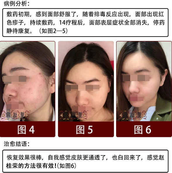 牡丹江赵桂荣中医：激素脸排激素是怎样一种体验？
