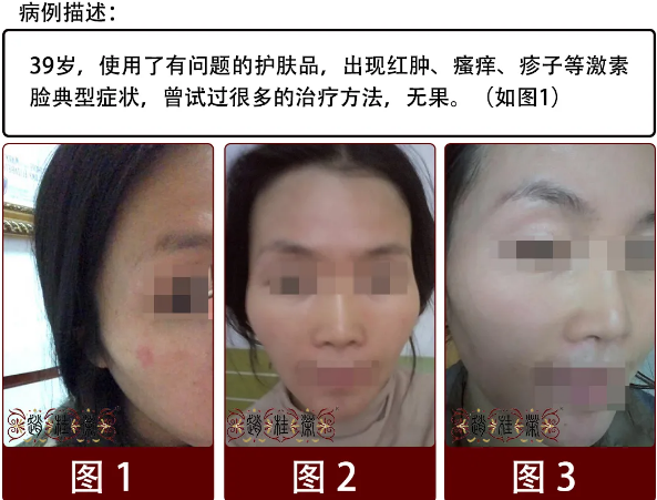 牡丹江赵桂荣中医：激素脸排激素是怎样一种体验？