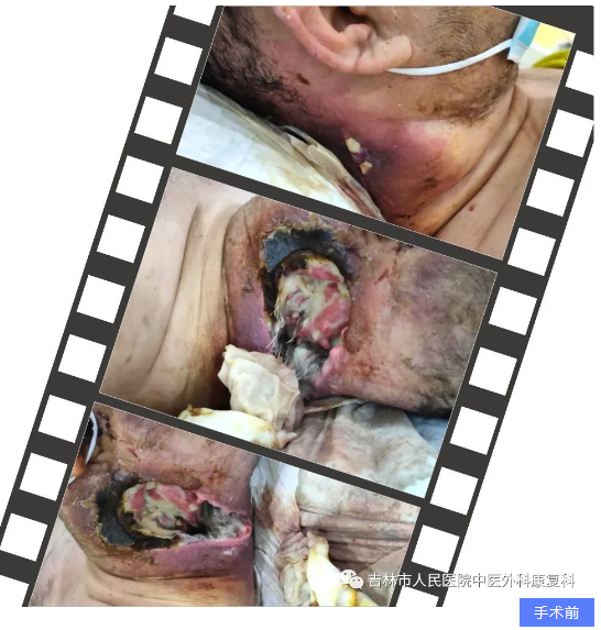 吉林市人民医院：（医案）疫情下抢救头颈部坏死性筋膜炎患者