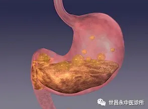 榆树市世昌永中医：常见诱发慢性胃溃疡的病因有什么