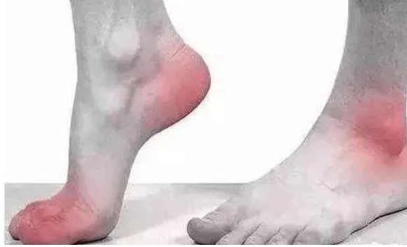 长春恒康中医：大拇指脚趾痛风的症状？如何有效治疗痛风？
