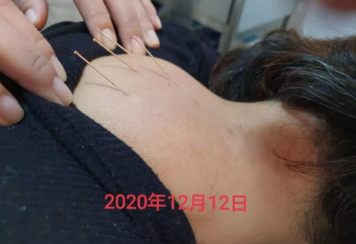 上海应象中医（医案）：杨永晓医生用针灸治疗富贵包