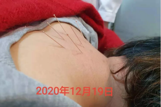 上海应象中医（医案）：杨永晓医生用针灸治疗富贵包