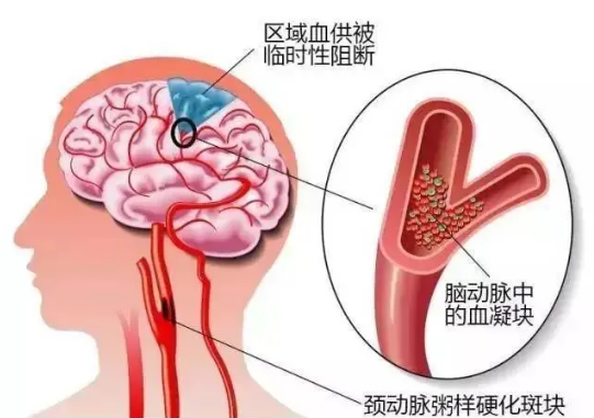 北京同春堂中医：中医告诉您一个防治心脑血管疾病的方法