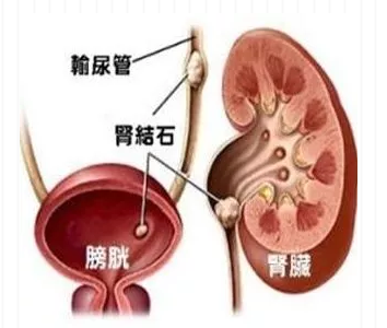 上海泰坤堂（医案）：应荐医生如何治疗输尿管结石