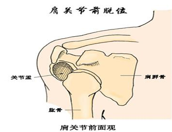 北京有明中医：（医案）罗氏正骨法：肩关节脱位的治疗