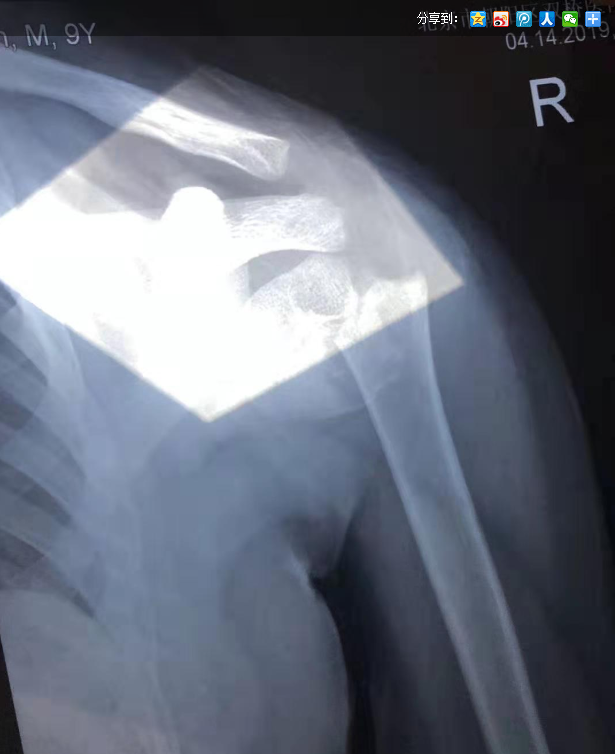 北京有明中医：（医案）10岁小朋友左肩摔伤骨折，在有明中医治愈