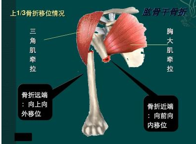 北京有明中医：（医案） 罗氏正骨法：肱骨干骨折的治疗