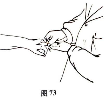 北京有明中医：（医案）罗氏正骨法：指骨骨折的治疗