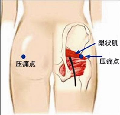 北京有明中医：（医案）梨状肌损伤的诊断与治疗