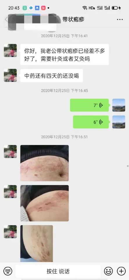 郑州管城康氏中医馆：缠腰龙——带状疱疹