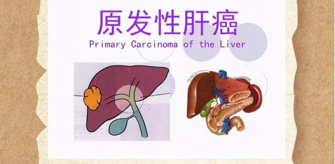 深圳维明生中医馆：肝癌出现腹水，病情进入中晚期，中医怎么治疗？