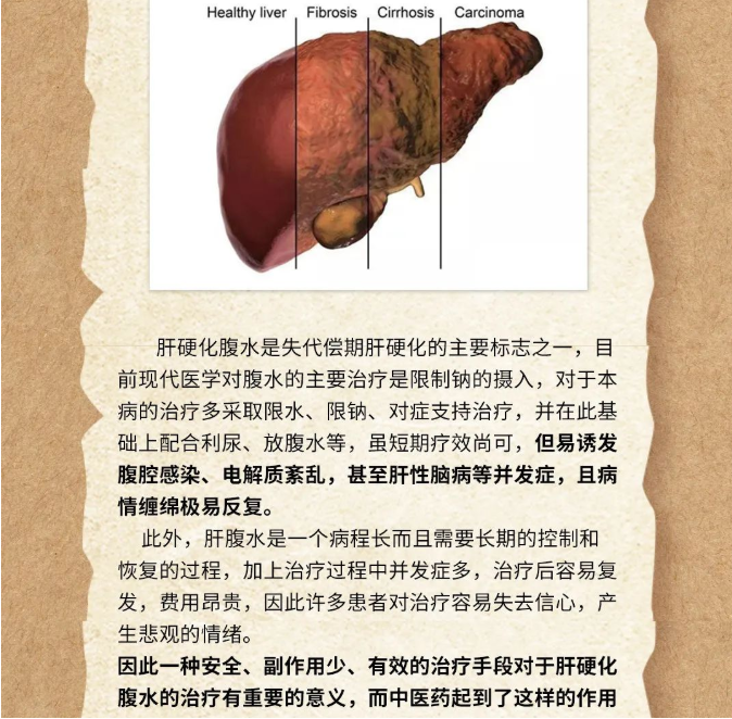 深圳维明生中医馆：肝腹水怎么治疗？肝腹水怎样防止复发？