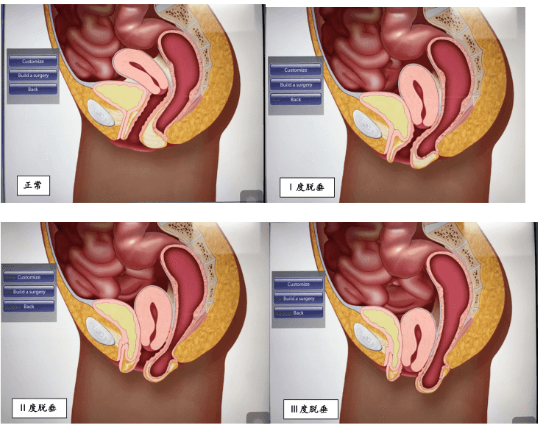 子宫脱垂手术子宫下垂图片