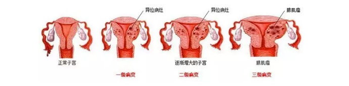 郑州管城康氏中医馆：子宫腺肌症（医案）