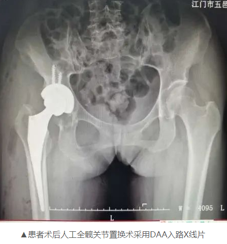 江门市五邑中医院（医案）：中医如何治疗关节脱臼