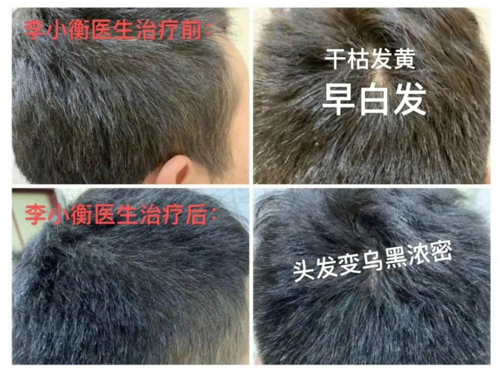 湖南九芝堂中医馆——中医脱发科专家李小衡教授针对头发枯黄、白发的中医治疗