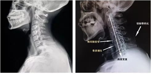 深圳鸣鹿中医诊所：5分钟颈部放松——麦肯基颈椎坐位练习法